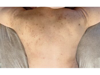 モネ(monet)/跡、色ムラにお悩みの方