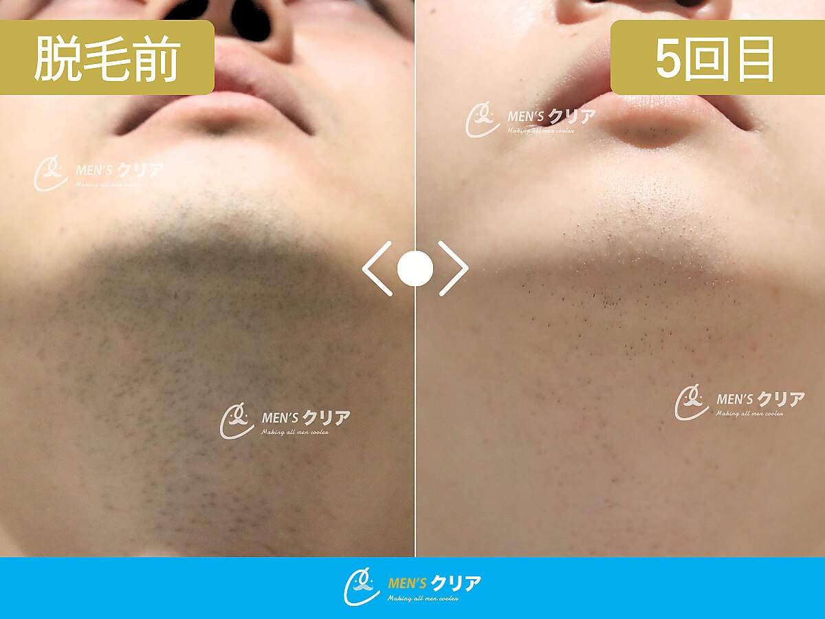 【5月限定】ヒゲ脱毛トライアル 初回10円（税込）#つるモテ肌 #毛穴