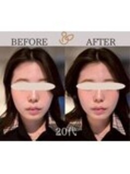 チョコバリ 錦糸町店(chocobari)/小顔×リフトアップ(美容鍼)20代