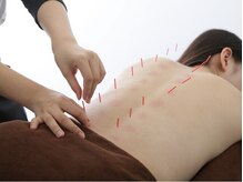 げんき堂接骨院 鍼灸院 津田沼/鍼ケアもお任せください！