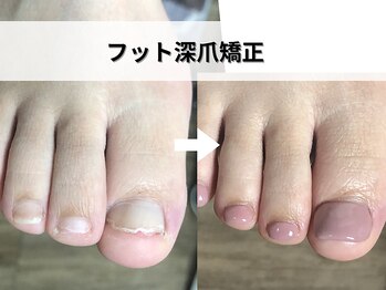 ブルームーンネイルズ(BLOOMOON.nails)/フット深爪矯正