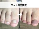 フット深爪矯正