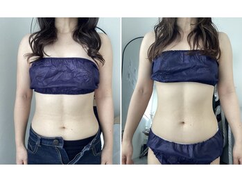 プレズィール(Plaisir)/脂肪冷却痩身　大カップ3回