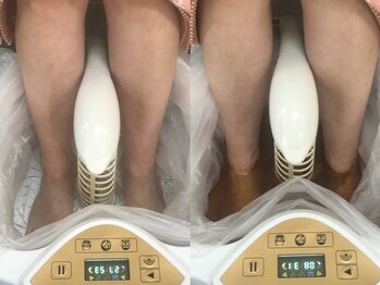 アイワ鍼灸整骨院の写真/【ご新規様限定☆ゴットクリーナー+カッピング￥6600】疲労回復+デトックスが同時に叶うクーポンご用意◎