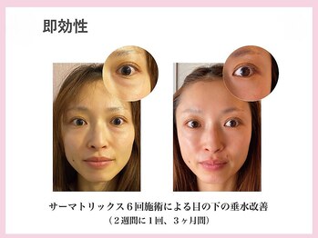 ラディアント たまプラーザ/気になる目の下のたるみに