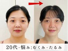 ジョンミー(JONMEE)/たるみ・むくみに小顔カッサ