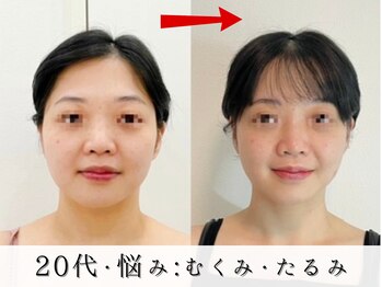 ジョンミー(JONMEE)/たるみ・むくみに小顔カッサ