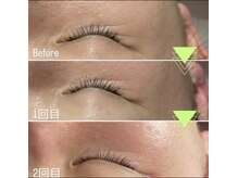 マロン(MARON)の雰囲気（ラミネーションピール/縦じわ/横じわ）