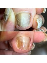 ナチュール(Nature)/肥厚爪施術