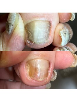 ナチュール(Nature)/肥厚爪施術