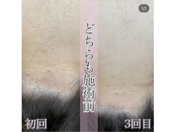 ラエッセ(LAESSE)/ハイパワー脱毛機で賢く脱毛♪