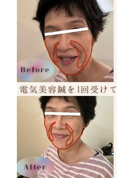 ソメイユ(Sommeil)/美容鍼ビフォーアフター.3