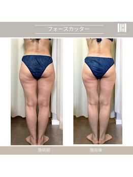 カリスボーテ 関本店/フォースカッター