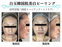 スパイア(SPIRE)/白玉韓国美白ピーリング