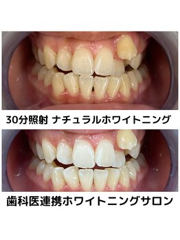 プラチナムビューティ 四条烏丸店(PLATINUM Beauty)/ホワイトニング！Before./After!