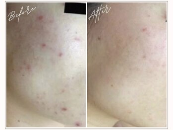 ミューベル(MYubelle)/ニキビ毛穴ケア 水光ピーリング