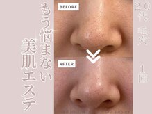 リボーン(Reborn)/20代　毛穴(1回)