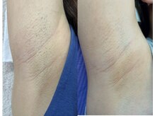 柑楠(カナウ)/ワキ脱毛もリーズナブル♪