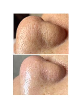 レンリー(Renry)/エイジングケアにもなる毛穴ケア