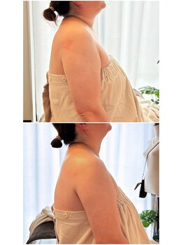 グリッタープラス(glitter plus)/二の腕の後ろ側の浮腫み軽減