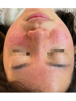 ビューティーメイクさくら/酒さ・ポツポツ肌改善