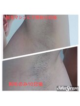 セルエス(sels)/メンズワキ脱毛