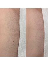 グルーミー(gloomy)/人気NO１！！VIO MIX脱毛★☆