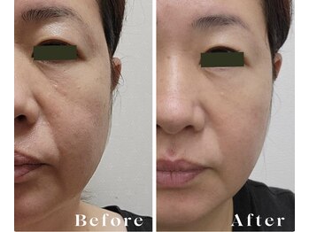 サロン ド グレース(Salon de Grace)/肌質改善×リフトアップ