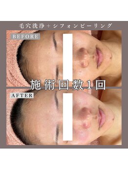 ベルミー(Bellmi)/毛穴洗浄×シフォンピーリング