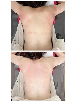 グリッタープラス(glitter plus)/肩周りと背中の浮腫みが軽減