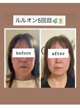 ヨサパーク リアン(YOSA PARK Lien)/モニター様before→after