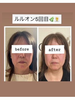 ヨサパーク リアン(YOSA PARK Lien)/モニター様before→after