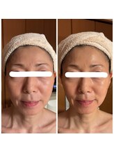 ジフィー(Gify)/筋膜リリースカッターFacial