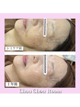 ミニョン(Mignon)/60代女性　シミ改善写真