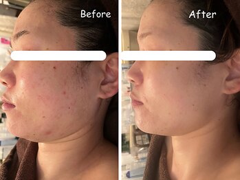 レイ(REI)/◆毛穴の開き◆