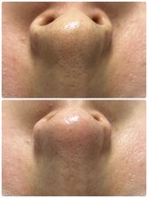 ホワイトアクア 浜松店(WHITE AQUA)/ハイドラワン/毛穴洗浄