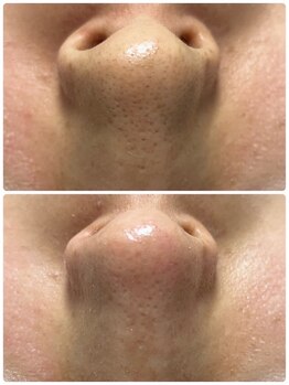 ホワイトアクア 浜松店(WHITE AQUA)/ハイドラワン/毛穴洗浄