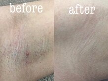 トリンテ バイ フェース(TRINTE by FAITH)/【ワキ脱毛】経過写真