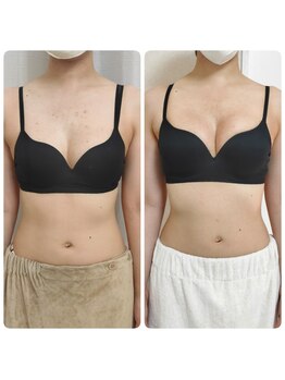 美人バスト リグラス(ReGrous)/バストアップbefore,after