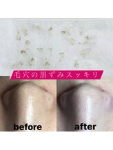 ビューティーネイル(Beauty Nail)/毛穴エクストラクション