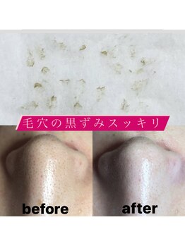 ビューティーネイル(Beauty Nail)/毛穴エクストラクション