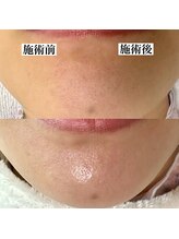 エミナル(eminal)/ビフォー/アフター/毛穴/梅田