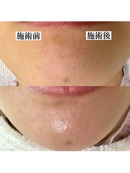 エミナル(eminal)/ビフォー/アフター/毛穴/梅田