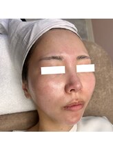 ホワイトワックス 京都四条烏丸(WHITE WAX)/《全顔》フェイシャルワックス