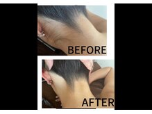 シード(SHE°)/うなじ脱毛