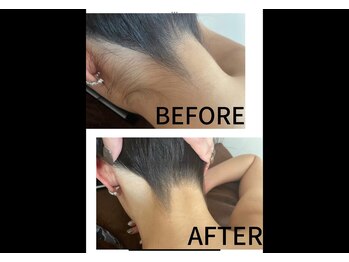 シード(SHE°)/うなじ脱毛