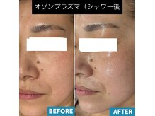 いやされサロン フー(fuu+)/プラズマシャワーで、美肌GET！