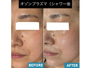 いやされサロン フー(fuu+)/プラズマシャワーで、美肌GET！