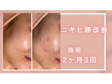 シャルナ(charna)/ニキビ/跡改善