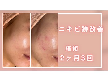 シャルナ(charna)/ニキビ/跡改善